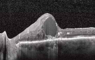 diabetic Retinopathy