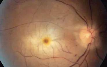 Retinal Artery Occlusion