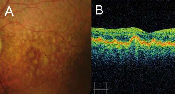 Macular-Degeneration1