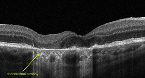 Macular-Degeneration2