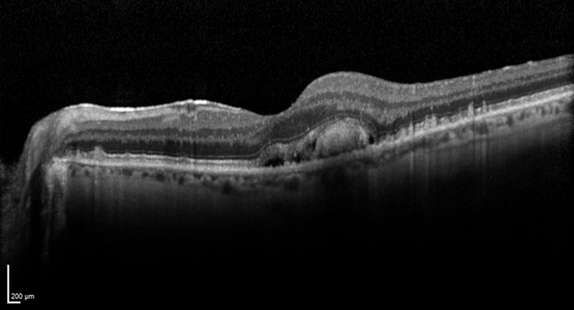 Macular-Degeneration3