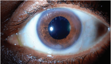 Retained Lens Fragments