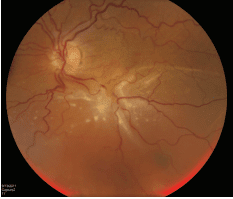 Proliferative Vitreoretinopathy