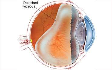 Retinal Detachment