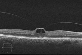 Vitreomacular Traction Syndrome