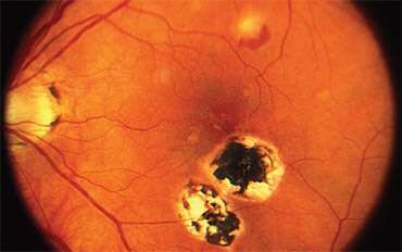 Vitrectomy Floaters Plainfield